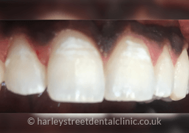 Teeth Whitening Harley Street